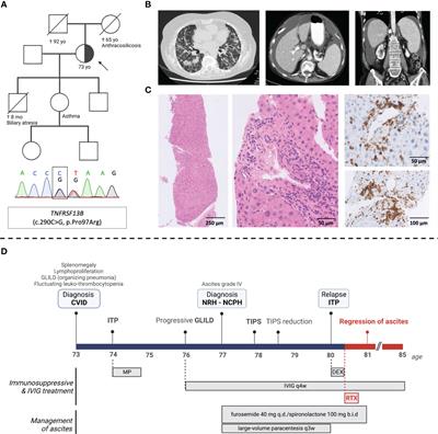 Rituximab and improved nodular regenerative hyperplasia-associated non-cirrhotic liver disease in common variable immunodeficiency: a case report and literature study